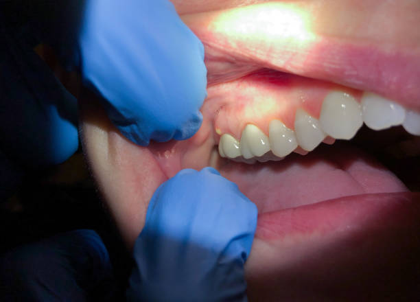 Best Emergency Treatment for Dental Infections or Abscesses in Gainesville, TX
