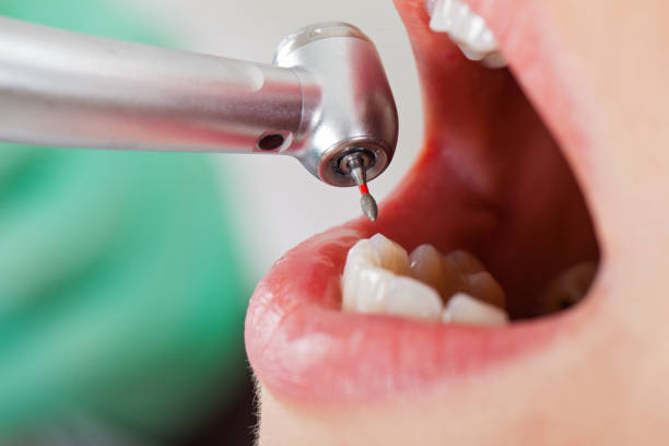 Best Emergency Dental Care for Broken or Chipped Teeth in Gainesville, TX